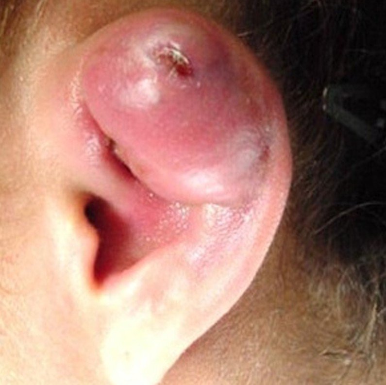 Little Bumps on the Ears | LIVESTRONG.COM