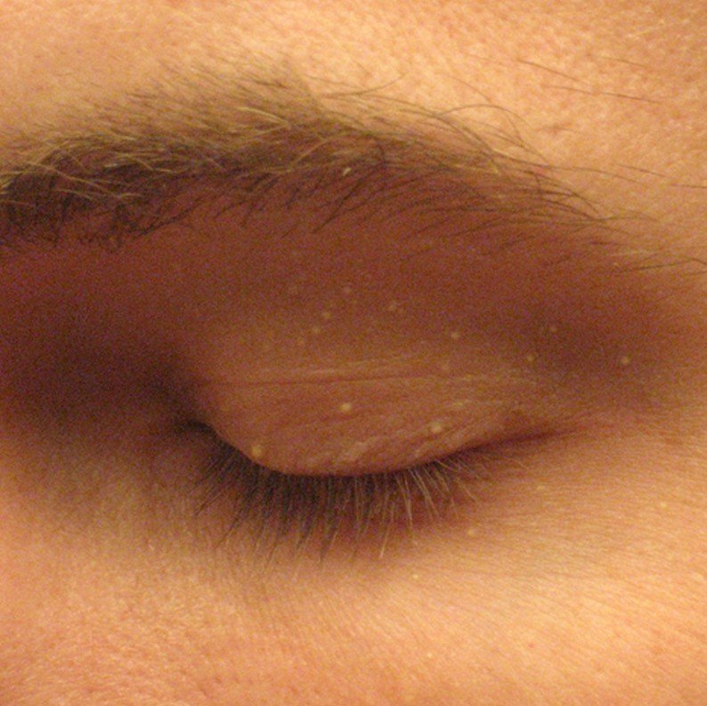 Eyelid bump - Symptoms, Treatments and.