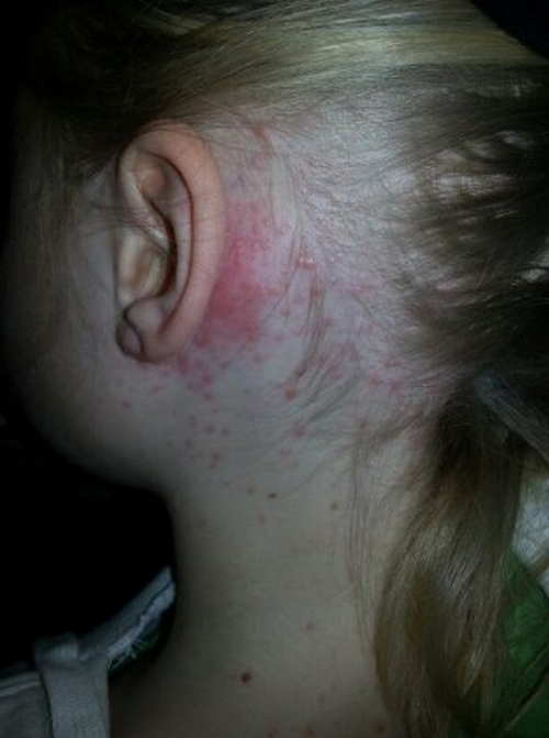 rash-behind-ear-pictures-causes-and-treatment