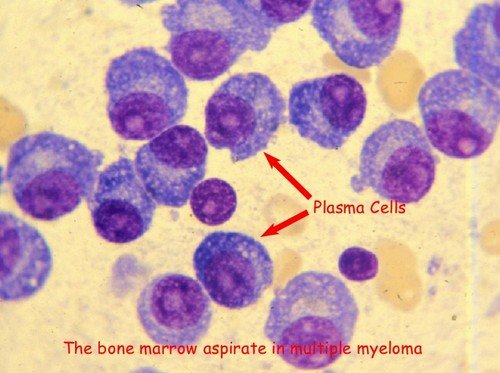 A closer look at the plasma cells in a patient with multiple myeloma.image