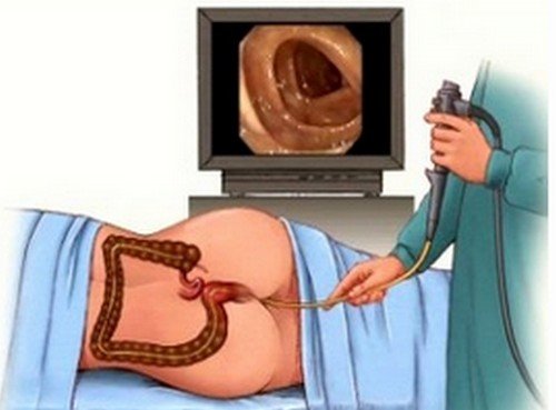 A colonoscopy procedure to check the hepatic flexure and splenic flexure of the colon.photo