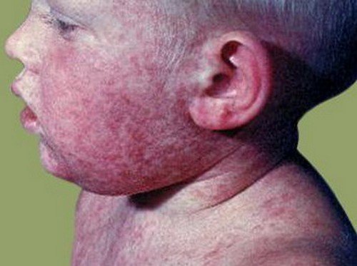 A rash behind the ear of a paediatric patient, which is caused by rubella virus.photo