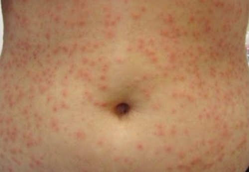 A severe form of chlorine rash affecting the abdomen and the upper torso.image
