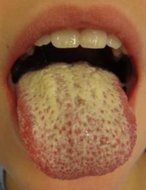A tongue with a yellowish to greenish discoloration.photo