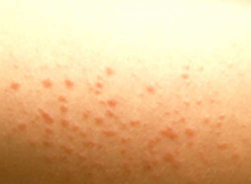 A typical clinical manifestation of a chlorine rash.image
