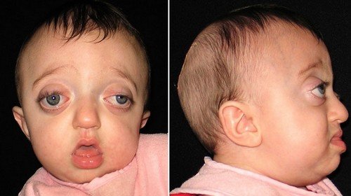 An eight month old child with Pfeiffer syndrome, with prominent bulging of the eyes, wide set eyes, high forehead, and underdeveloped jaw.photo