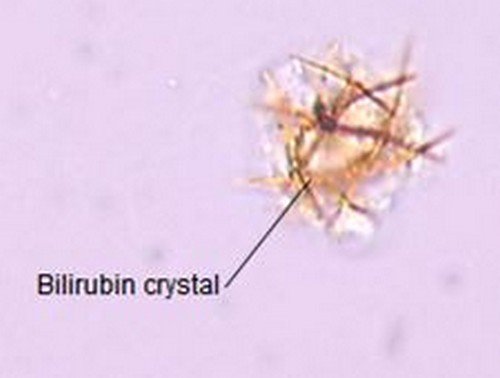An image of bilirubin crystals.photo