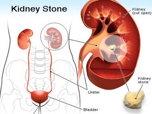 Kidney stones, one of the reasons for inner thigh pain.image