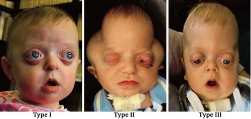 The different types of Pfeiffer syndrome.image