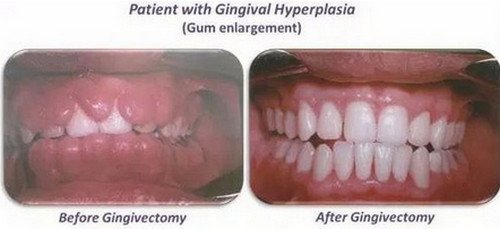 A before and after image of a patient with gingival hyperplasia who underwent gingivectomy pictures