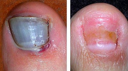 A before and after photo of a bruised toenail.image