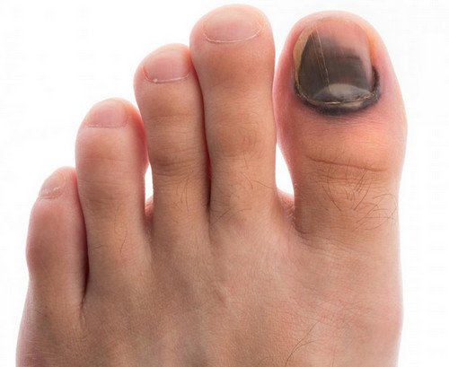A bruised nail of the big toe with a blackish skin discoloration.photo