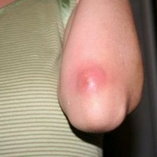 A large and reddened boil on the elbow area.photo