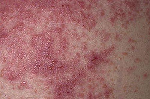 A large number of tiny red bumps on the skin which is a clinical manifestation of dermatitis herpetiformis.image