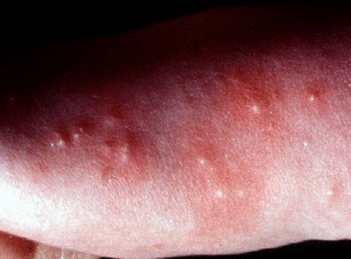 A patient with clinical manifestations of papular urticaria.image