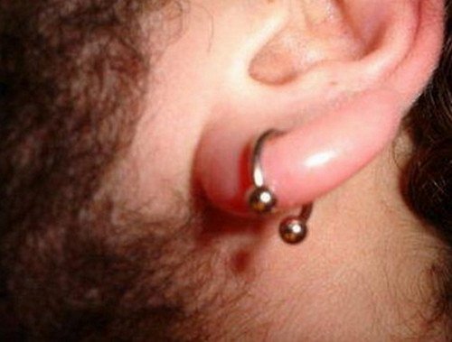 A person with a swollen ear lobe secondary to piercing infection.image