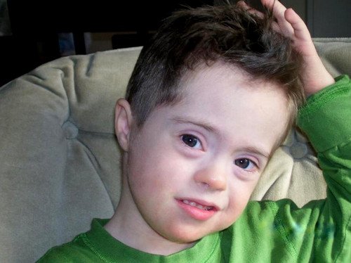 A photo of a child with mild mosaic down syndrome.image