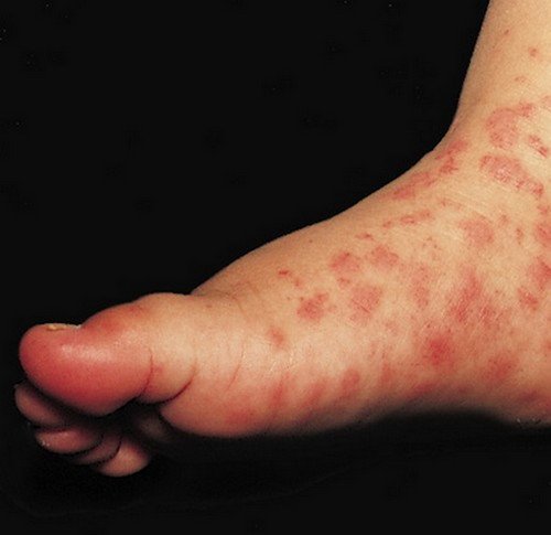 A severe form of papular urticaria.photo