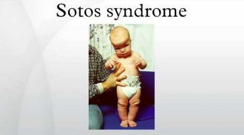 An image of a child with Sotos syndrome with prominently large head circumference and wide set eyes.photo