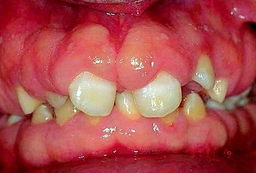 An image of a patient suffering from severe form of gingival hyperplasia.photo