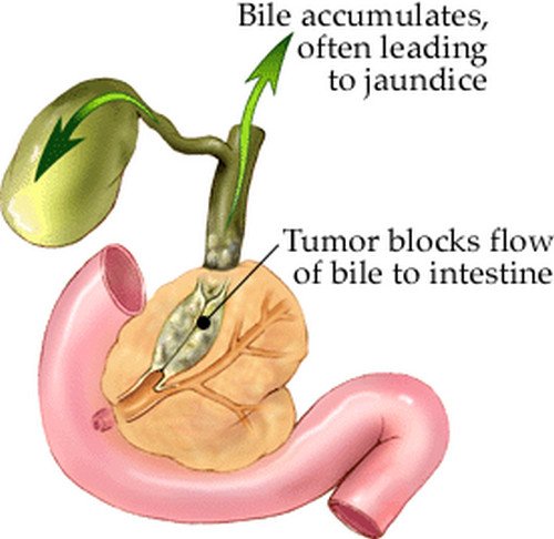 An obstructed bile duct could cause orange diarrhea. In the photo, the bile duct is obstructed by a tumor.photo