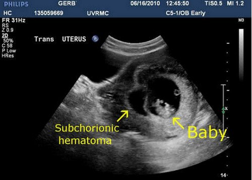 An ultrasound view of what appears to be a huge black hematoma (subchorionic hematoma) right beside the fetus pictures