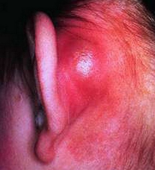 Swollen earlobe secondary to mastoiditis.image