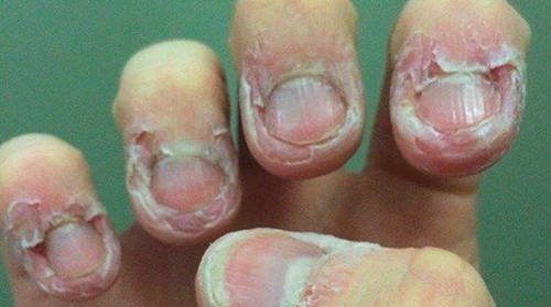 A severely distorted fingernails and skin caused by excessive biting of the nails Dermatophagia image photo picture