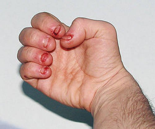 Nails dermatophagia image photo picture
