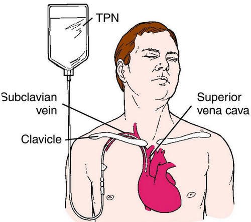 A cartographic image of the total parenteral nutrition site image photo picture