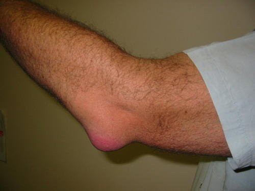 Olecranon bursitis on the elbow image photo picture